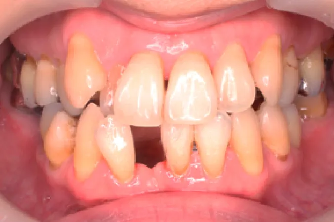 【【症例1】周囲の歯を削らずに、セラミックの差し歯で治療　女性 40代