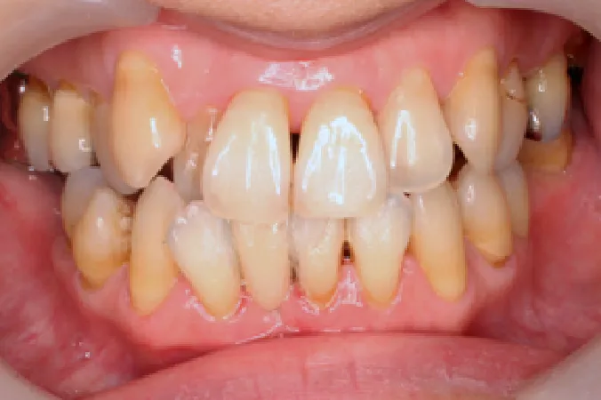 【【症例1】周囲の歯を削らずに、セラミックの差し歯で治療　女性 40代